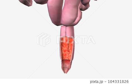 Pouchitis ;Many people with severe ulcerative colitis have their diseased colon removed and their intestines reattached in a surgical procedure known as ileoanal anastomosis (IPAA). Pouchitis ;Many people with severe ulcerative colitis have their diseased colon removed and their intestines reattached in a surgical procedure known as ileoanal anastomosis (IPAA). 104331826