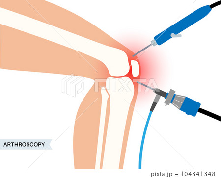 Knee joint arthroscopy 104341348