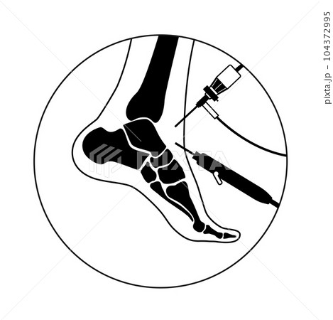 Ankle arthroscopy poster 104372995