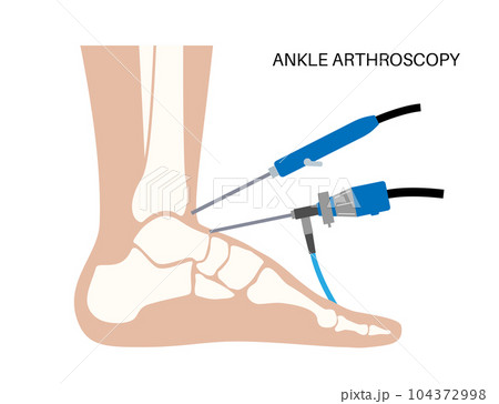 Ankle arthroscopy poster Ankle arthroscopy poster 104372998