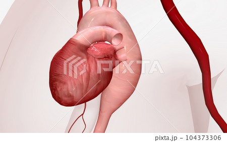 The Thoracic Aortic Aneurysm 3D The Thoracic Aortic Aneurysm 3D 104373306