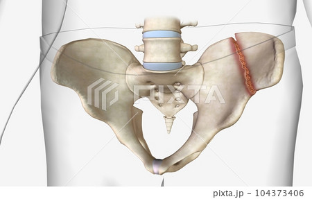 Pelvic fractures are classified as stable or unstable 104373406