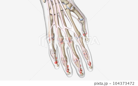Psoriatic Arthritis Effects on Hand Joints 104373472