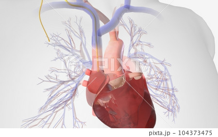 Pulmonary Artery Catheter Insertion into the Right Atrium 104373475