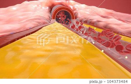 Hypercholesterolemia is a condition characterized by higher than 104373484