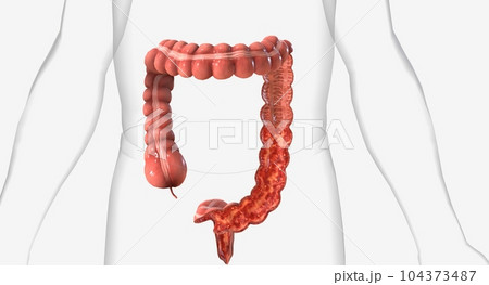 Ulcerative colitis chronic inflammation of the lining of the large intestine characterized by the formation of ulcers 104373487