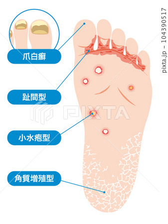 水虫の種類 104390517