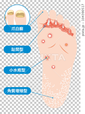 水虫の種類 104390517