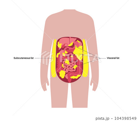 Visceral fat diagram Visceral fat diagram 104398549