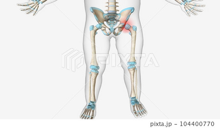 Hip dysplasia occurs when the hip socket is too shallow 104400770