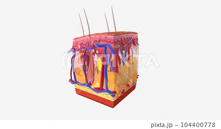 Angioedema is a swelling of the dermis and subcutaneous tissue. 104400778