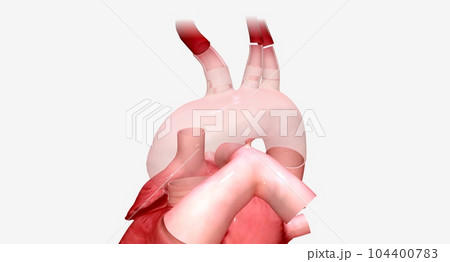 The enlarged portion of the aortic arch is replaced with a synthetic graft. 104400783