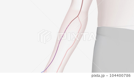 Catheter Advancement through Radial Artery 104400786