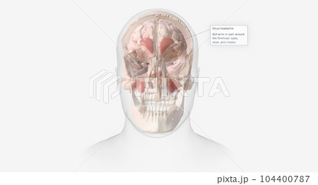 Sinus headaches are a type of headache characterized by a dull ache or pain around the forehead, eyes, nose, and cheeks. 104400787