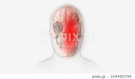 Migraine headaches are characterized by recurrent, throbbing pain affecting one side of the head. 104400790