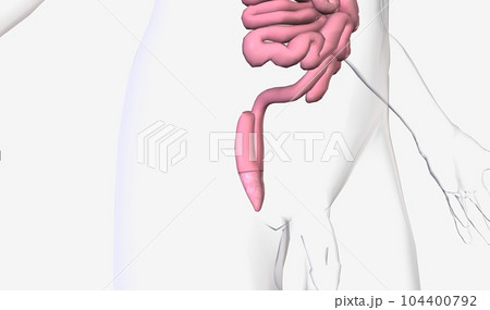 Ileoanal anastomosis surgery allows removal of the upper and low 104400792