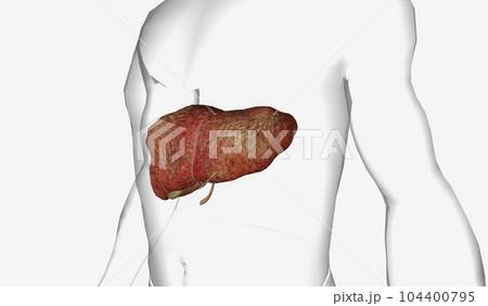 Primary biliary cholangitis (PBC) is an autoimmune disease of th 104400795