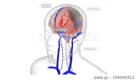 If head trauma occurs, increased stress on the bridging veins can cause them to tear. 104400822