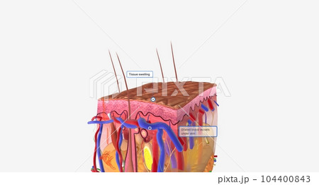 Angioedema is a swelling of the dermis and subcutaneous tissue. 104400843