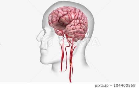 Ischemic stroke is an urgent medical condition characterized by Ischemic stroke is an urgent medical condition characterized by 104400869