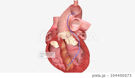 In alcohol septal ablation, a small amount of pure alcohol is released into an artery at the septum. In alcohol septal ablation, a small amount of pure alcohol is released into an artery at the septum. 104400873