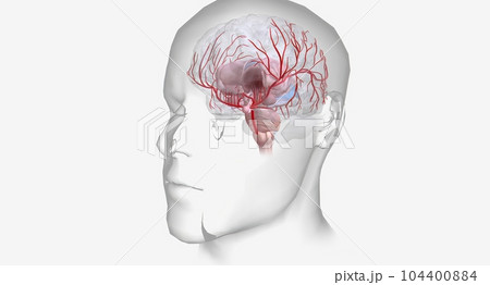 Hemorrhagic stroke is an urgent medical condition characterized Hemorrhagic stroke is an urgent medical condition characterized 104400884
