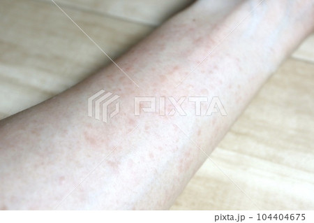 コリン性蕁麻疹を発症した男性の腕 コリン性蕁麻疹を発症した男性の腕 104404675