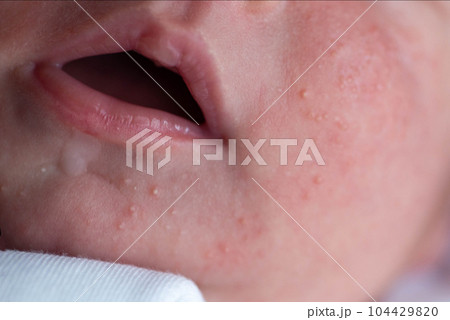 Pimples on the face of a newborn. Baby's adaptation to the environment, close-up Pimples on the face of a newborn. Baby's adaptation to the environment, close-up 104429820