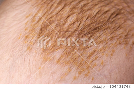 The process of formation of seborrheic dermatitis in an infant on the head. Scaly crusts, close-up The process of formation of seborrheic dermatitis in an infant on the head. Scaly crusts, close-up 104431748