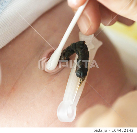 Treatment of the navel and umbilical cord of a newborn with hydrogen peroxide and a cotton swab to dry and heal the umbilical cord of an infant. Medical Treatment of the navel and umbilical cord of a newborn with hydrogen peroxide and a cotton swab to dry and heal the umbilical cord of an infant. Medical 104432142