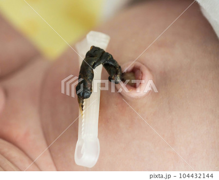 Remains of the umbilical cord with a clip in a newborn. Treatment and care of the navel in an infant. Close-up Remains of the umbilical cord with a clip in a newborn. Treatment and care of the navel in an infant. Close-up 104432144