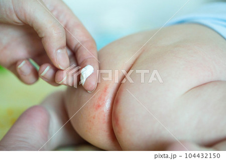 The mother applies a healing cream to the baby's red bottom. Healing ointment for diaper rash, irritation and redness on the delicate skin of a baby, close-up 104432150