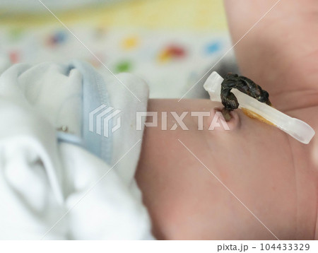 Remains of the umbilical cord with a clip in a newborn. Treatment and care of the navel in an infant. Close-up 104433329