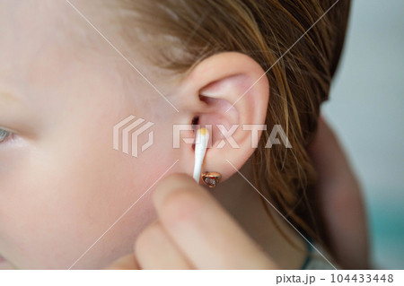 Cleaning a child's ear with a cotton swab from contamination of the ear drum and ear canal. Earwax as protection against microorganisms. Close-up Cleaning a child's ear with a cotton swab from contamination of the ear drum and ear canal. Earwax as protection against microorganisms. Close-up 104433448