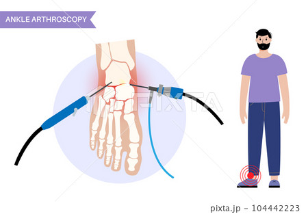 Ankle arthroscopy poster Ankle arthroscopy poster 104442223