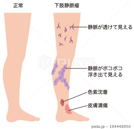 下肢静脈瘤 血管の病気 医療 下肢静脈瘤 血管の病気 医療 104448950
