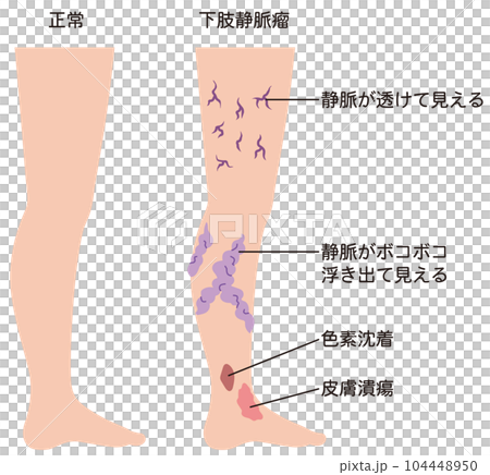 下肢靜脈曲張疾病醫療 下肢靜脈曲張疾病醫療 104448950