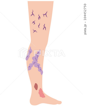 下肢静脈瘤　血管の病気　医療 104452750
