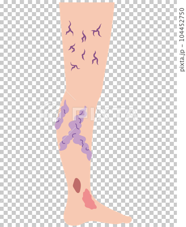 下肢靜脈曲張疾病醫療 104452750