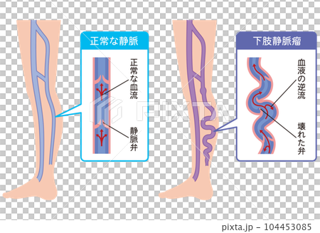 下肢靜脈曲張疾病醫療 下肢靜脈曲張疾病醫療 104453085