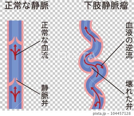 Lower extremity varicose vein disease medical care 104457128