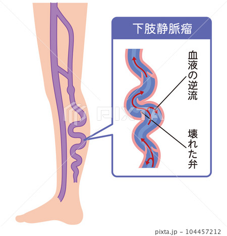 下肢静脈瘤　血管の病気　医療 104457212