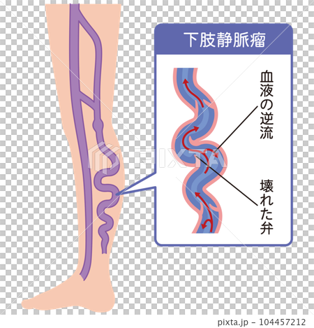 Lower extremity varicose vein disease medical care Lower extremity varicose vein disease medical care 104457212