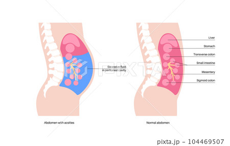 Ascites disease poster 104469507