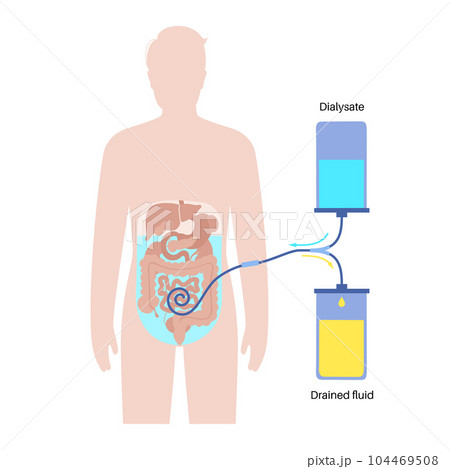 Peritoneal dialysis concept 104469508