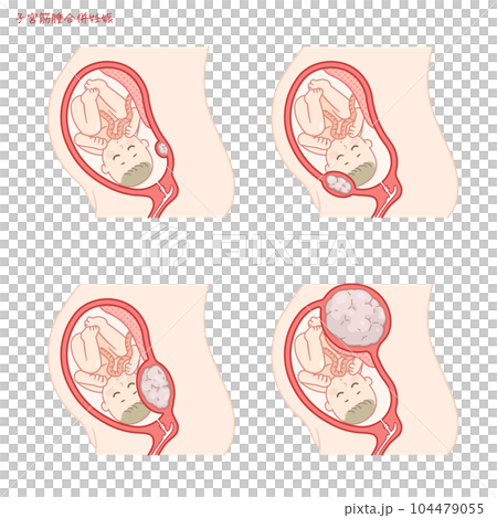 筋腫合併妊娠のイラスト、子宮筋腫、妊娠中、子宮筋腫のある女性 104479055