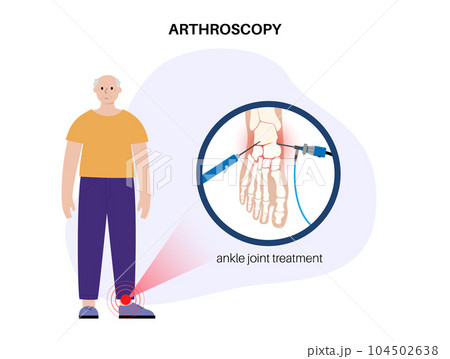 Ankle arthroscopy poster 104502638