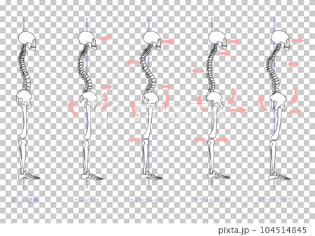 Skeleton set with bad posture seen from the side Skeleton set with bad posture seen from the side 104514845