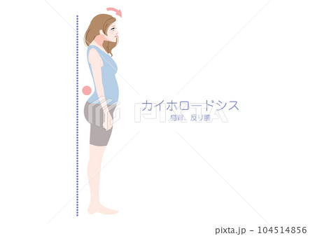 横から見たカイホロードシス姿勢の女性 104514856