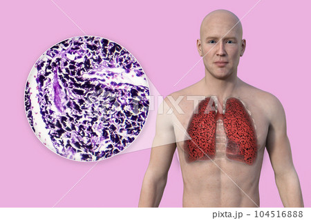 A 3D illustration of the upper half part of a man with transparent skin, revealing the condition of smoker's lungs 104516888